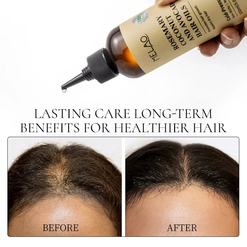 Rosemary Essential Hair Loss Oil Growth Oil Hair Strengthening Dandruff Itchy Deep Rosemary Coconut Avocado Hair Oil